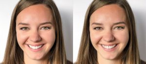 Ortodoncia Invisible con Invisalign Bogotá